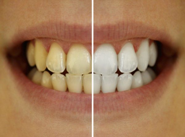 Whitening tennene er enklere enn noen gang