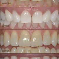 Grin365 cierre comodidad Blanqueamiento de dientes Kit
