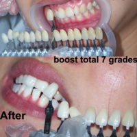 Dentist Clinic Professional Teeth Whitening Light Apply to Dental Chair with 6 LEDs Equipment