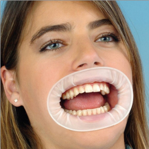 10X Dental Disponibel Sterile kofferdam Teeth Whitening Oral Cheek Retractor Mouth Åpner CE
